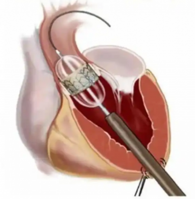 經導管主動脈瓣系統fg17000-av23